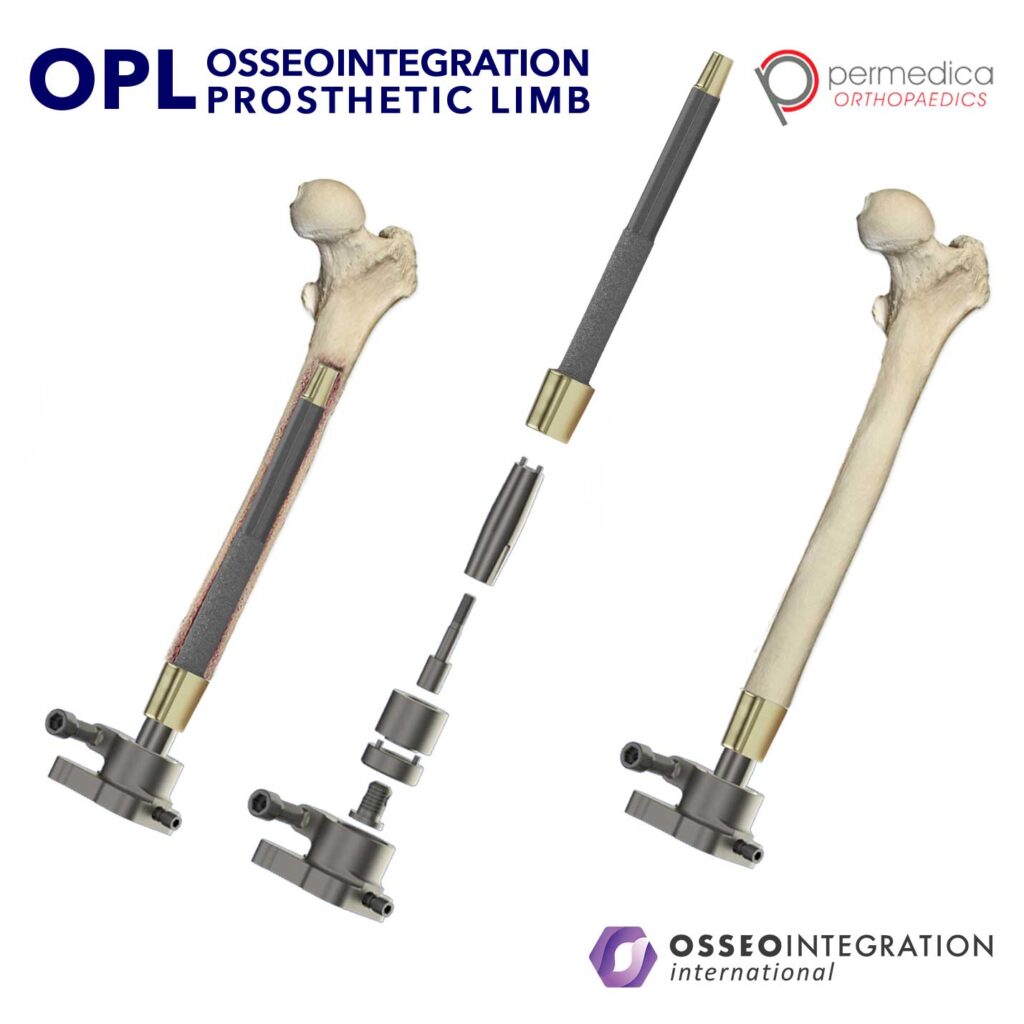 Osseointegration Prosthetic Limb